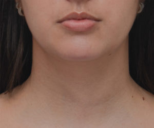 Neck Liposuction Before & After Patient #1948