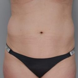 Liposuction with Bodytite Before & After Patient #1557