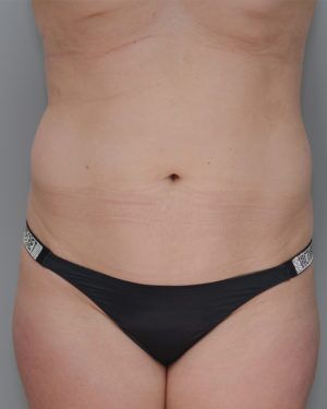 Liposuction Before & After Patient #1646