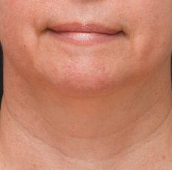 Facetite Before & After Patient #1776
