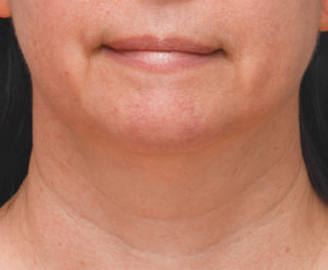 Facetite Before & After Patient #1776