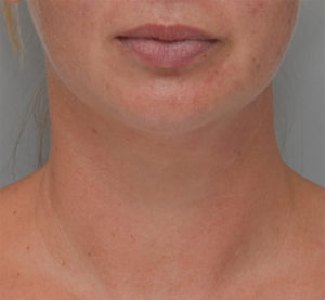 Facetite Before & After Patient #1881