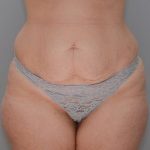 Abdominoplasty Before & After Patient #1270