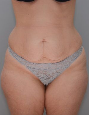 Abdominoplasty Before & After Patient #1270