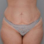Abdominoplasty Before & After Patient #1642