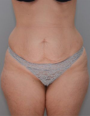 Liposuction Before & After Patient #1642