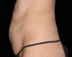 Emsculpt Neo Before & After Patient #2158