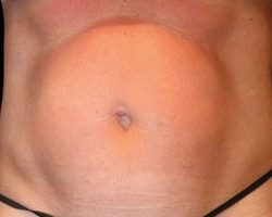 Emsculpt Neo Before & After Patient #2161