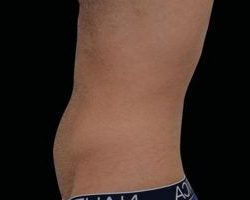 Emsculpt Neo Before & After Patient #2160