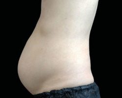 Emsculpt Neo Before & After Patient #2159