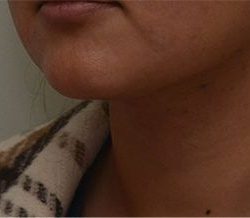 Neck Liposuction Before & After Patient #2004