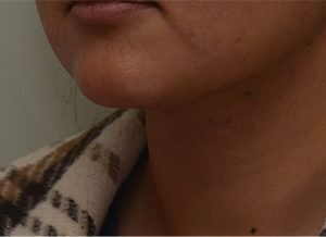 Neck Liposuction Before & After Patient #2004