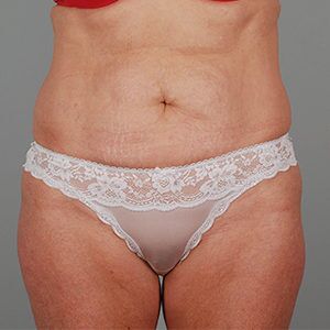 Abdominoplasty Before & After Patient #1209