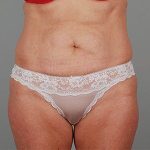 Abdominoplasty Before & After Patient #1588