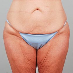 Abdominoplasty Before & After Patient #1327