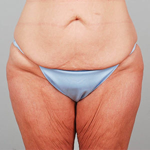 Abdominoplasty Before & After Patient #1327