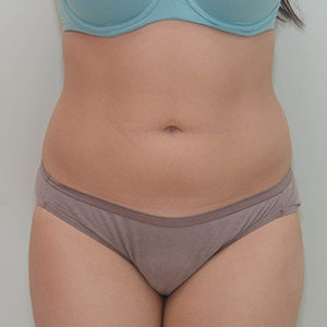 Abdominoplasty Before & After Patient #1208