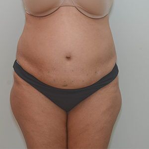 Liposuction Before & After Patient #1586