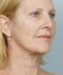 Laser Skin Resurfacing Before & After Patient #2218