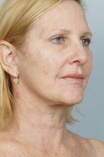 Laser Skin Resurfacing Before & After Patient #2218