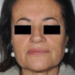 Laser Skin Resurfacing Before & After Patient #2197