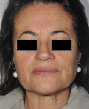 Laser Skin Resurfacing Before & After Patient #2197