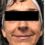 Laser Skin Resurfacing Before & After Patient #2214