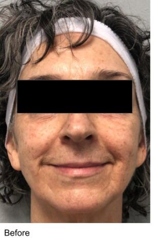 Laser Skin Resurfacing Before & After Patient #2214