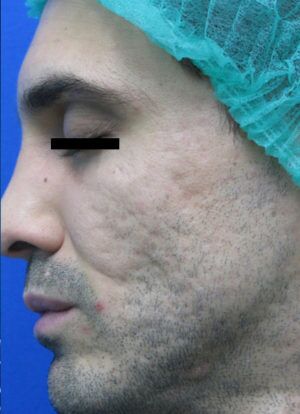 Laser Skin Resurfacing Before & After Patient #2201