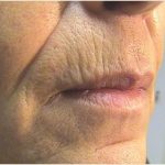 Laser Skin Resurfacing Before & After Patient #2199