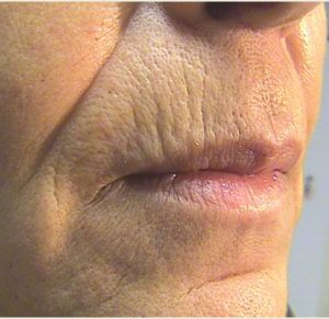 Laser Skin Resurfacing Before & After Patient #2199