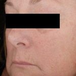 Laser Skin Resurfacing Before & After Patient #2216