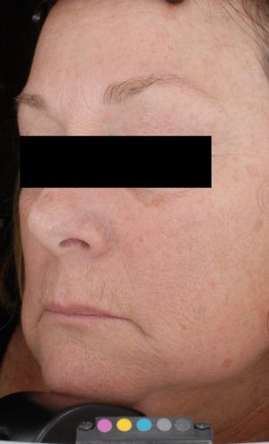 Laser Skin Resurfacing Before & After Patient #2216