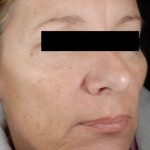 Laser Skin Resurfacing Before & After Patient #2215