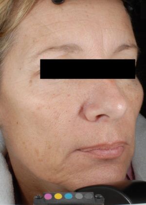 Laser Skin Resurfacing Before & After Patient #2215