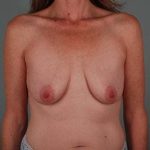 Breast Lift Before & After Patient #957