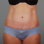 Abdominoplasty Before & After Patient #1330