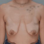 Breast Lift Before & After Patient #898