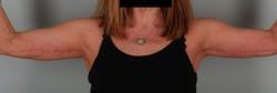 Arm Lift Before & After Patient #1540
