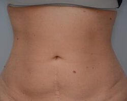 Emsculpt Neo Before & After Patient #2174
