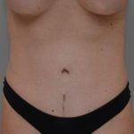 Abdominoplasty Before & After Patient #1493
