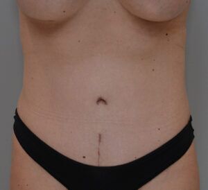 Abdominoplasty Before & After Patient #1493