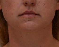 Neck Liposuction Before & After Patient #2008
