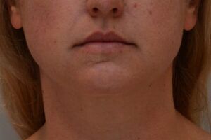 Neck Liposuction Before & After Patient #2008