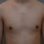 Gynecomastia Before & After Patient #1160