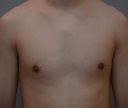 Gynecomastia Before & After Patient #1160