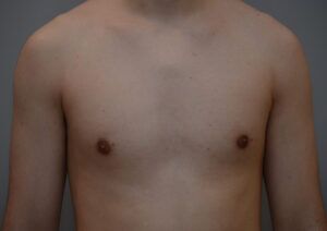 Gynecomastia Before & After Patient #1160