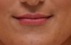 Lip Filler Before & After Patient #2246