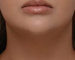 Neck Liposuction Before & After Patient #2007