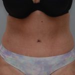 Abdominoplasty Before & After Patient #1496